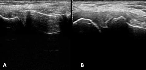 Figure 2 From The Value Of Ultrasound Diagnostic Imaging Of Meniscal