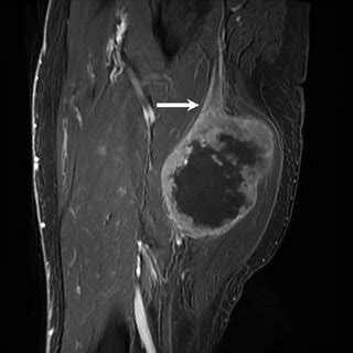 Sagittal T Fat Saturated Mri Image With Contrast Shows Predominantly