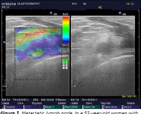 Figure 3 From Differential Diagnosis Of Malignant Cervical Lymph Nodes