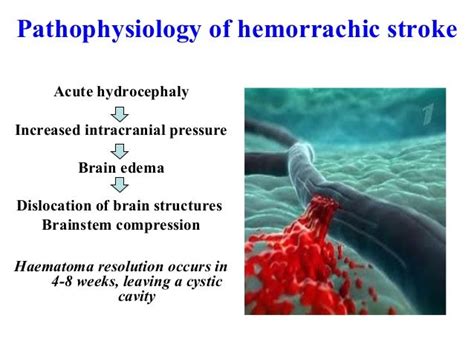 Hemorrhagic stroke