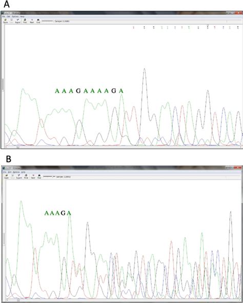 Con Fi Rmation By Sanger Sequencing Of The Germline 5 Bp Deletion In