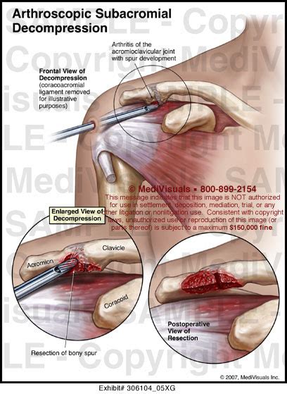 Arthroscopic Subacromial Decompression Medical Illustration