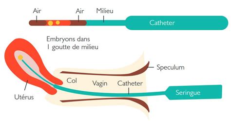 FIV étape 6 le transfert embryonnaire Groupe santé CHC