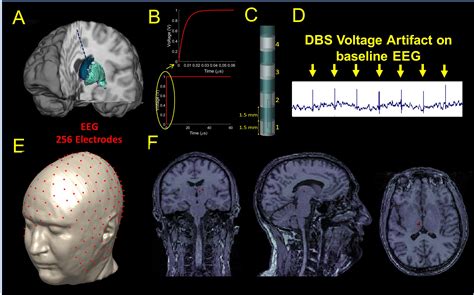 Frontiers A Study On The Feasibility Of The Deep Brain Stimulation