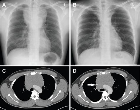 Mediastinal Germ Cell Tumor