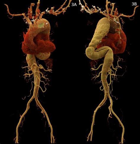 Anomalous Origin Of Right Vertebral Artery From Aortic Arch Distal To