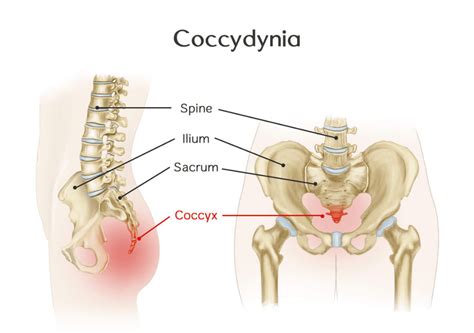 Coccydynia (Tailbone Pain) | Orchard Health Clinic - Osteopathy ...