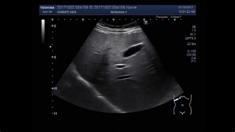 Gallbladder Hydrops Ultrasound