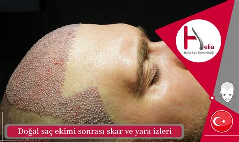 Doğal saç ekimi sonrası skar ve yara izleri Helia kliniği