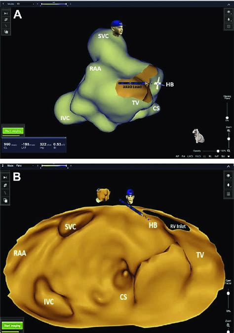 Right Atrial Anatomy And Final Permanent His Bundle Lead Position Download Scientific Diagram