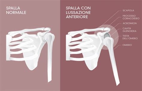 Sublussazione Della Spalla Tutore Si O Tutore No Dott Ssa Giulia Mayer