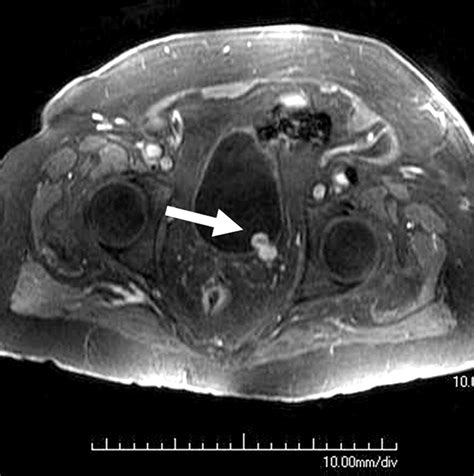 Mr Urography Techniques And Clinical Applications Radiographics