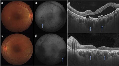 Colour Fundus Photographs Of Patient 1 Shows Serous Macular Detachment