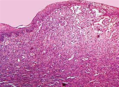 Photomicrograph Of A Gingival Pyogenic Granuloma Hematoxylin And Eosin