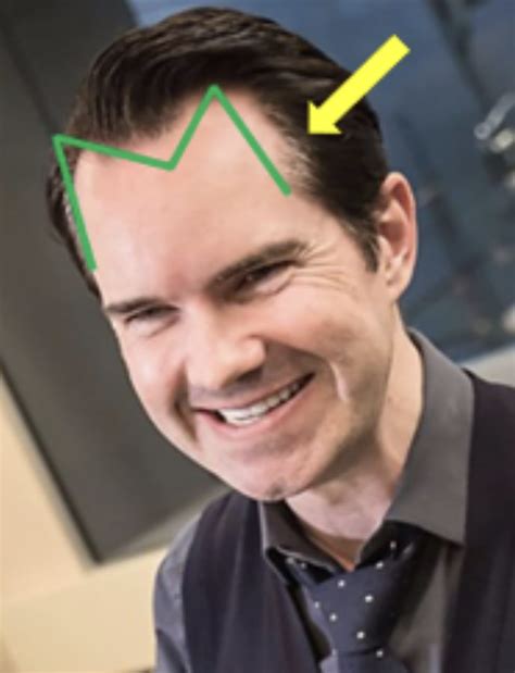 Jimmy Carr Hair Transplant Everything You Need To Know