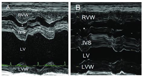 M Mode Echocardiographic Images Of The Right And Left Ventricles At