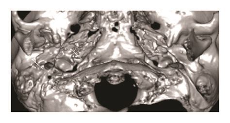 A The 3d Volume Rendering Technique Shows The Lateral Surface Of The Download Scientific