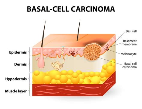 Cancro Della Cellula Basale O Del Basalioma Illustrazione Vettoriale