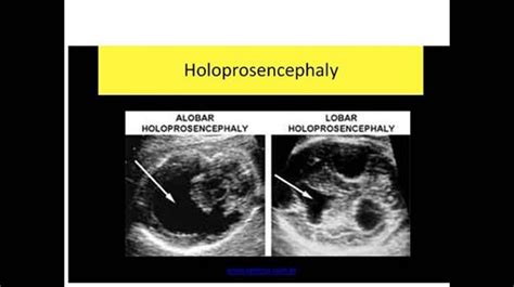 holoprosencephaly | Diagnostic medical sonography, Sonography, Ultrasound