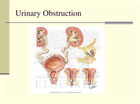 Ppt Urinary Obstruction And Benign Prostatic Hyperplasia Bph Powerpoint Presentation Id 3388031