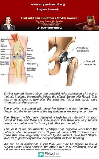 Stryker hip replacement | PDF