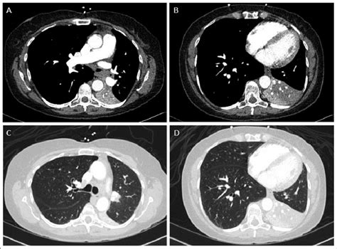 Chest CT scan showing complete collapse of the left lower lobe with... | Download Scientific Diagram