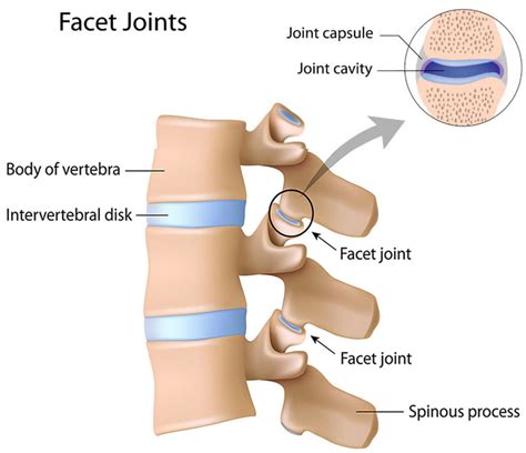 Arthropathy Definition Facet Arthropathy Lumbar Facet Arthropathy