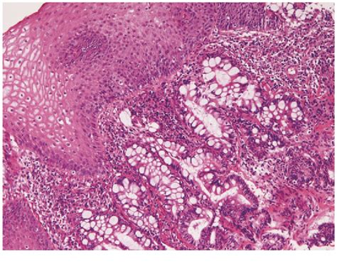 cmv esophagitis | Semantic Scholar