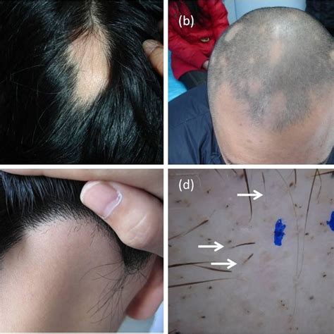 Clinical Presentations Of Alopecia Areata A Single Patch B Download Scientific Diagram