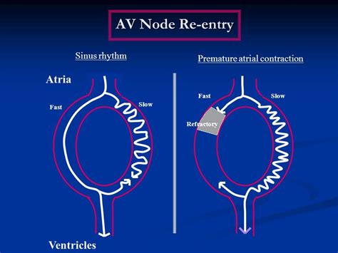 Atrial Nodal Reentrant Tachycardia