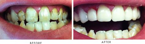 Before After Photos Alluvial Dental Center Fresno Ca