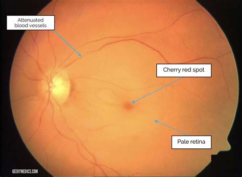 Patient Education Series Central Retinal Artery Occlusion Mata Clinic And Optometrist Blog