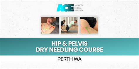 Hip And Pelvis Dry Needling Course Perth Wa Humanitix