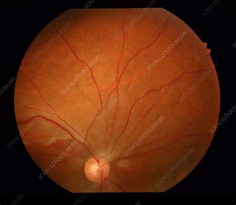 Retinal Vasculitis Fundoscopy Stock Image C Science