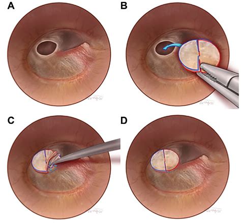 Tympanic Membrane Perforation Repair