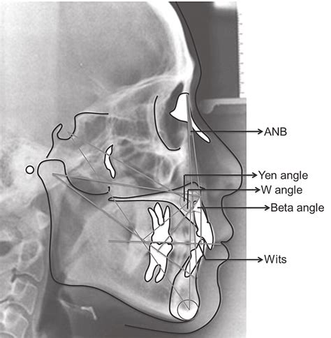 Cephalometric Tracing Anb Wits Appraisal Beta Angle W Angle And Yen Download Scientific