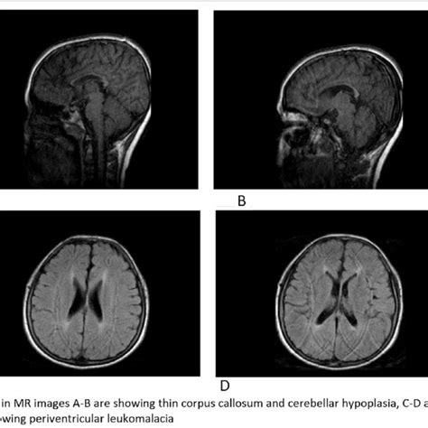 Brain MRI findings of the patient | Download Scientific Diagram