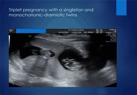 Twin Reversed Arterial Perfusion In One Foetus In A Triplet Pregnancy