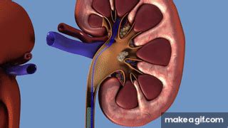 Tratamiento de cálculos renales y ureterales URS on Make a