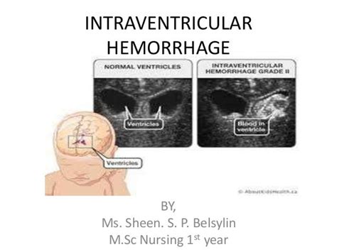 Intraventricular Hemorrhage Grades