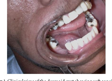 Figure 1 From Unusual Dermoid Cyst In Oral Cavity Semantic Scholar