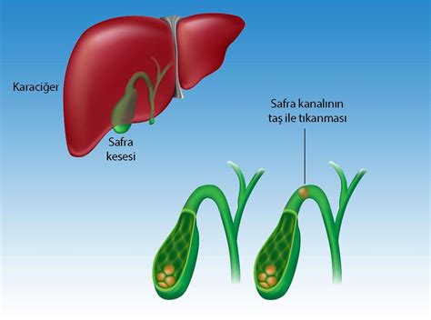 Safra kanalı taşı hastalığı koledokolitiazis belirtileri ve tedavisi