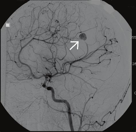 Angiography Showing Aneurysm Formation Measuring About Mm On