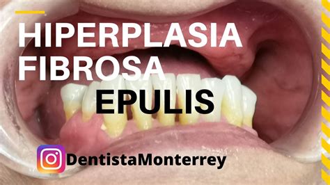 EPULIS HIPERPLASIA FibrosaCausada por Prótesis Dentales YouTube