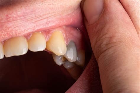 Why Do My Teeth Feel Loose Sometimes Causes And Treatment