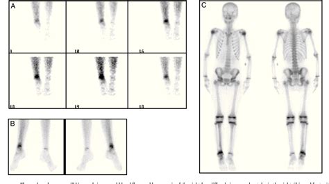 Osteomyelitis Bone Scan