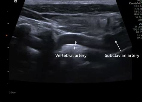 Vertebral Artery Stenosis Ultrasound