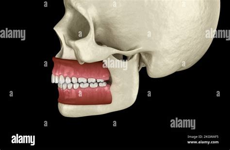 Overbite Dental Occlusion Malocclusion Of Teeth Stock Video Footage