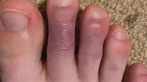 Why Are My Feet Itchy Our Top Tips For Itchy Toes And Feet My Footdr