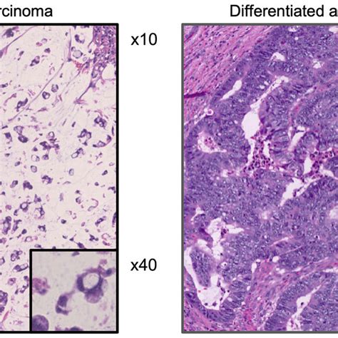 The Representative Microscopic View Of Signet Ring Cell Carcinoma In